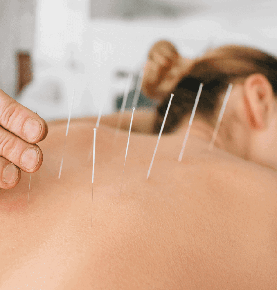 Acupuncture and Cupping Therapy Near Me – Acupuncture